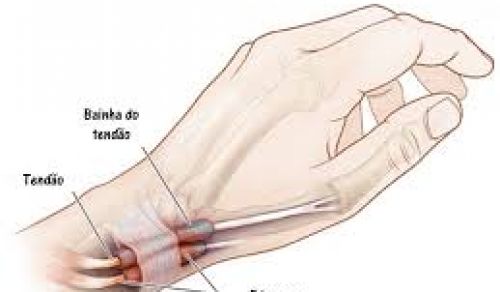 Tendinite De Quervain