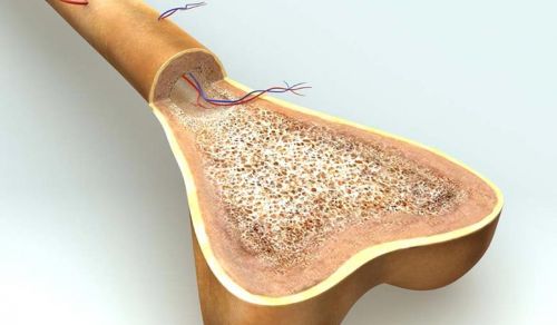 Diferenças entre osteopenia e osteoporose