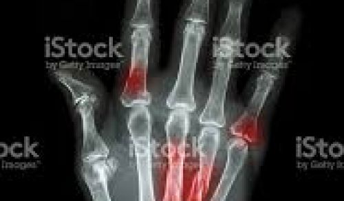 Fraturas na mão e membro superior