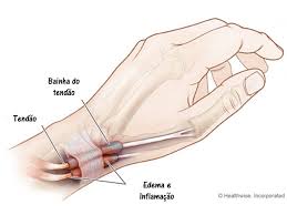 tendinite de quervain